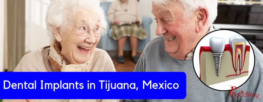 Best Dental Implants in Tijuana Mexico 